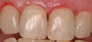 photo of teeth after procedure