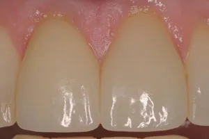 photo of teeth after procedure