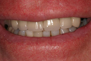 photo of teeth after procedure