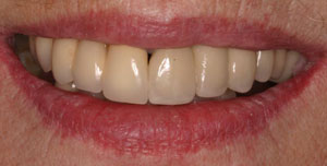 photo of teeth after procedure