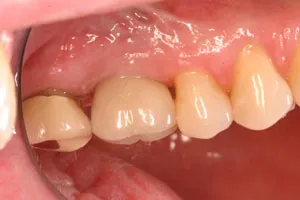 photo of teeth after procedure