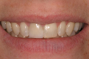 photo of teeth after procedure