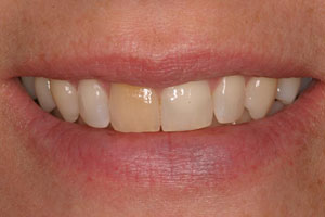 photo of teeth