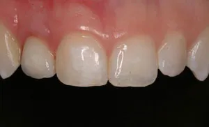 photo of teeth after procedure