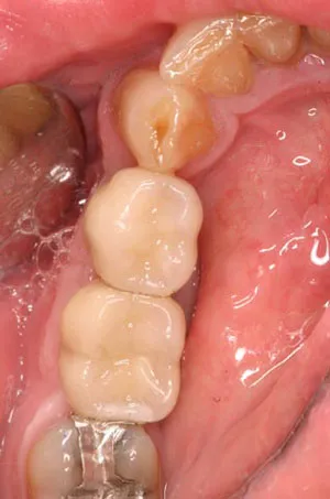 photo of teeth after procedure